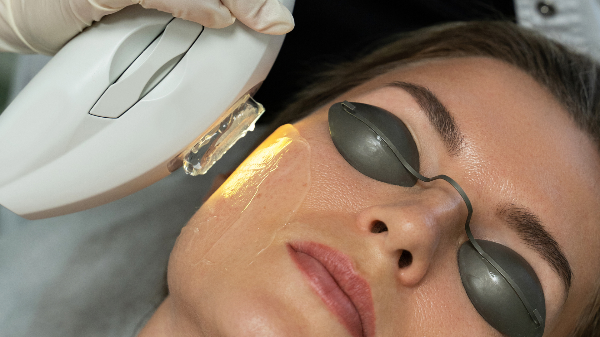Photofacial in Delhi