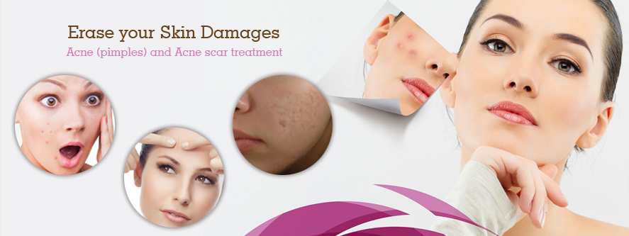 Acne Scar Treatment in Delhi