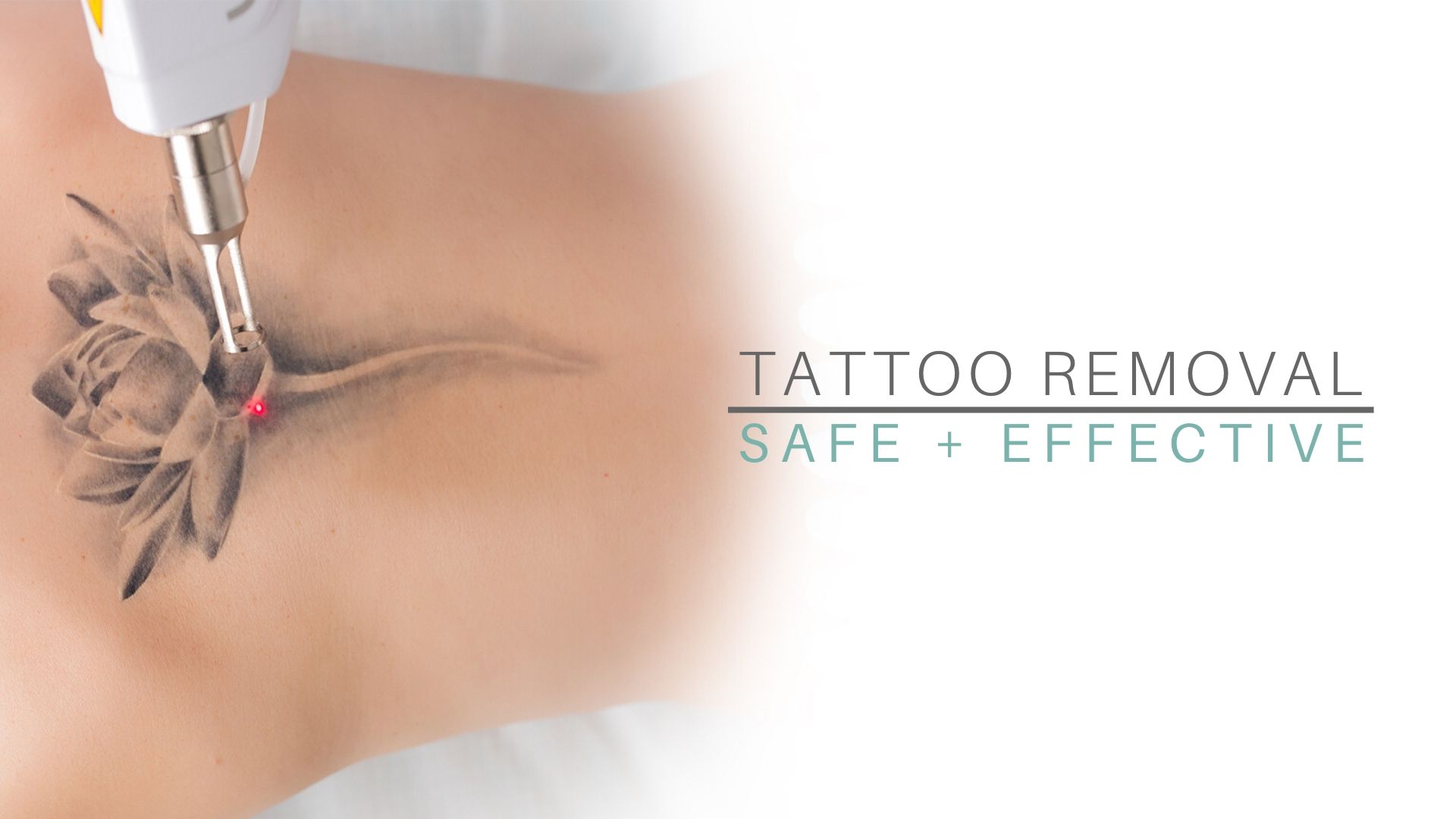 Laser Tattoo Removals