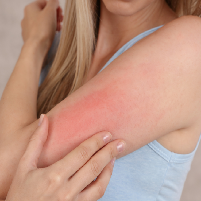 Allergy Treatment