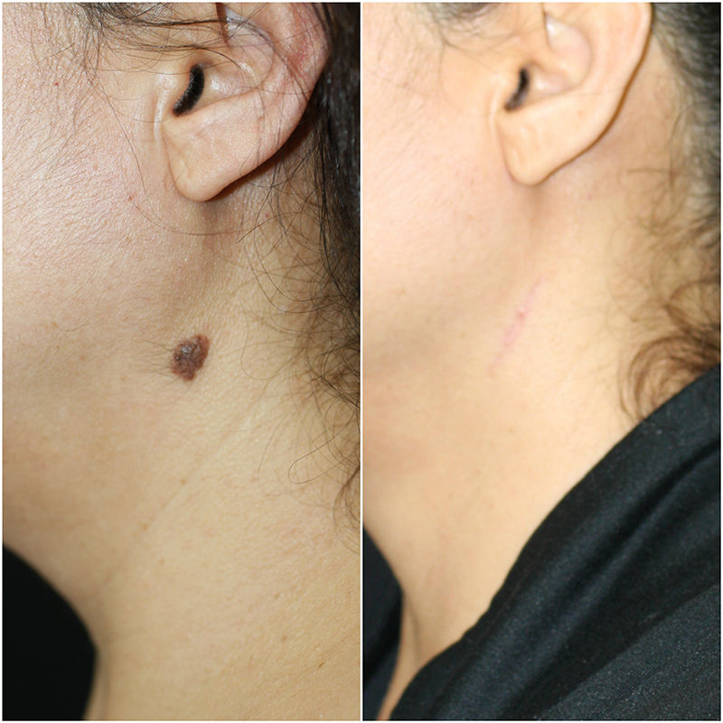 Mole Removal