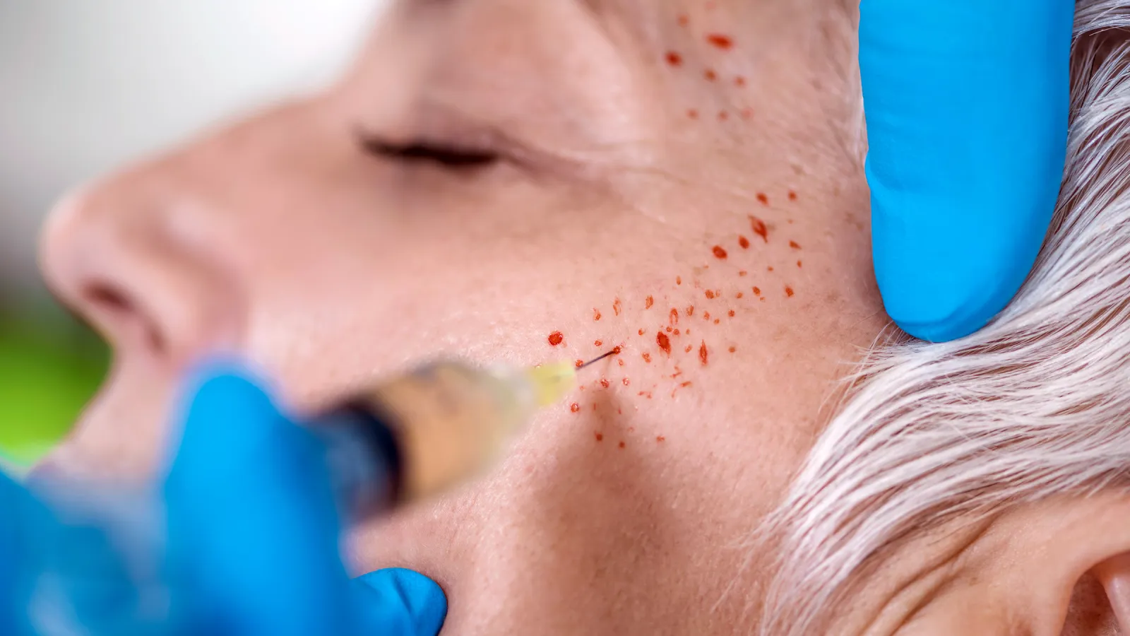 Vampire Facial